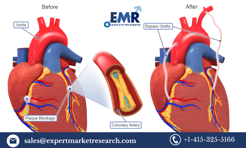 Coronary Artery Bypass Graft Procedures Market