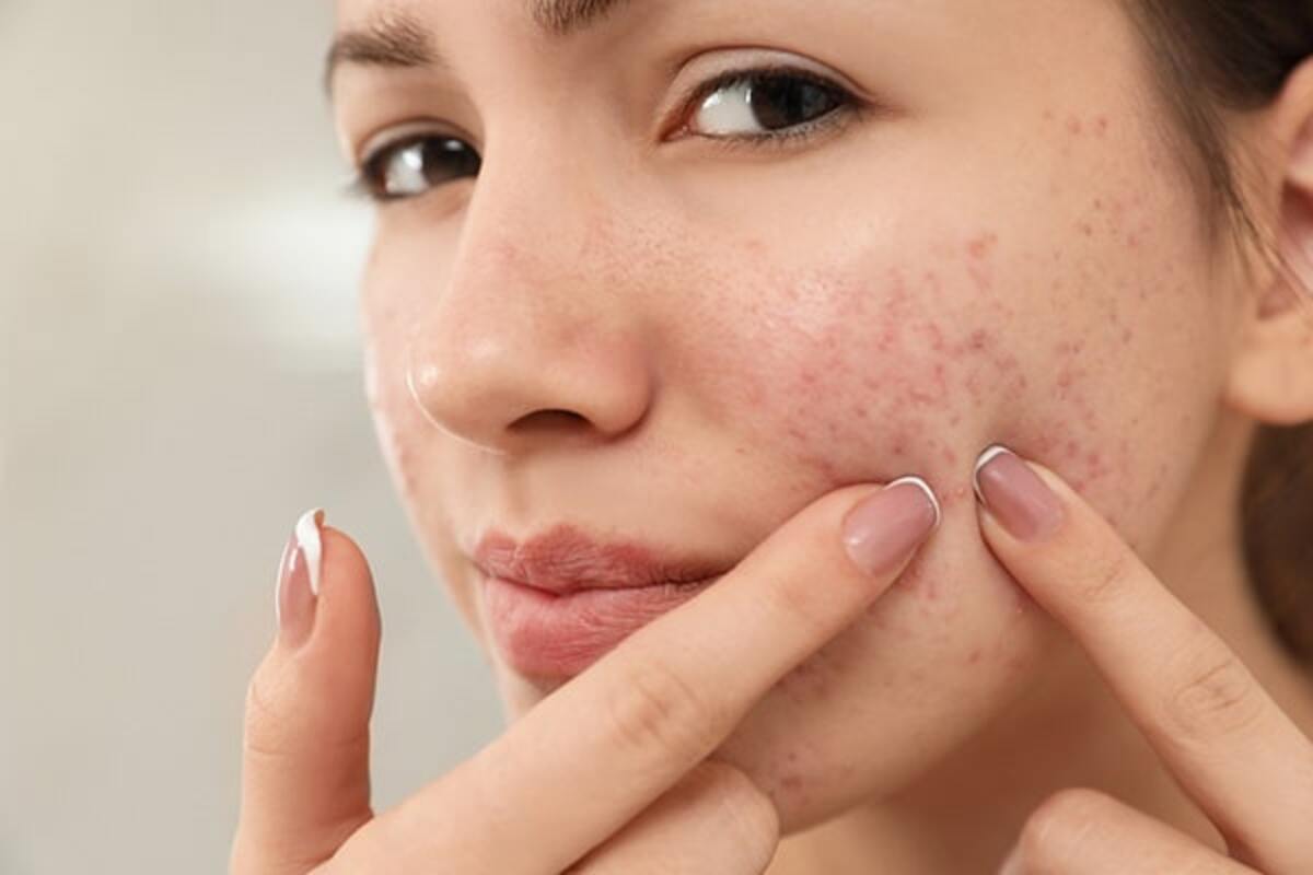 Effective Home Remedies for Acne Problems